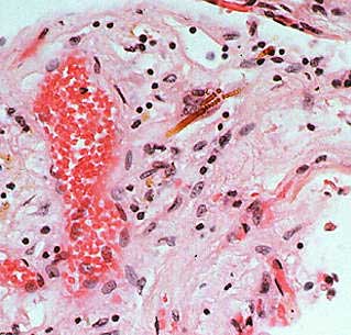 โรคปอดอักเสบจาก แร่ใยหิน หรือ Asbestos